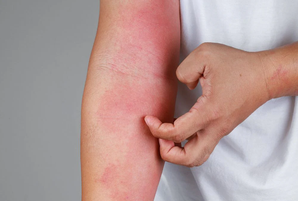 Diferença entre dermatite atópica e outras dermatites