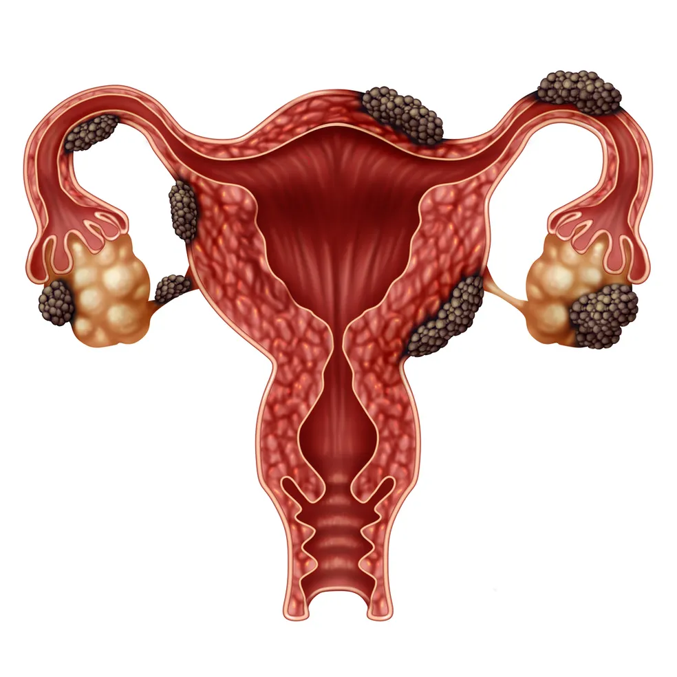 Guia de estudos: endometriose