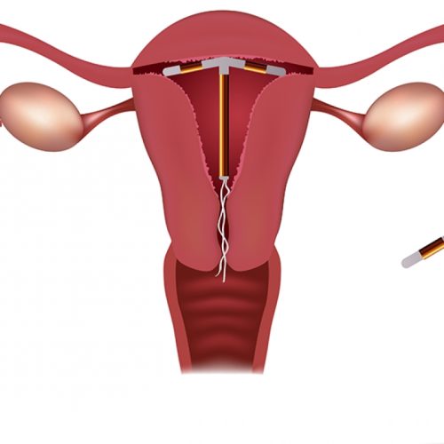 DIU: tudo o que você precisa saber