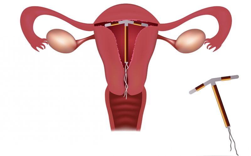 DIU: tudo o que você precisa saber