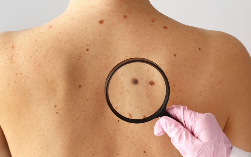 Câncer e oleosidade: existe ligação?