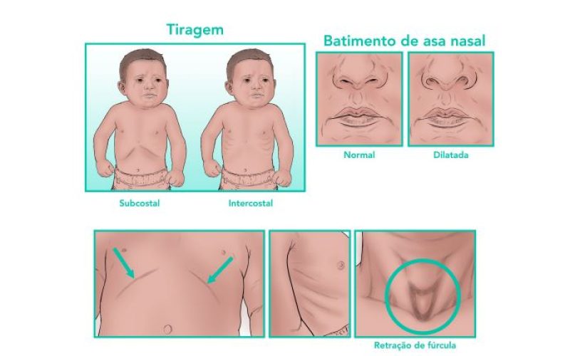 Guia de estudos: Bronquiolite viral aguda