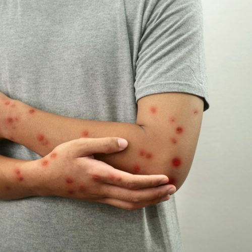 MPox está de volta? Entenda os riscos
