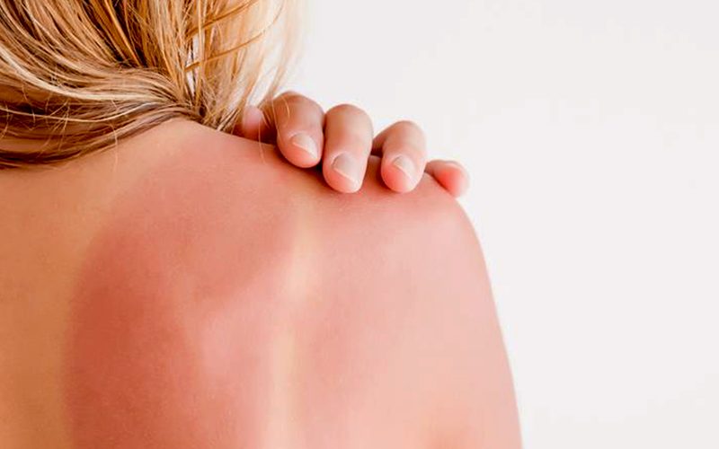 Insolação: perigo silencioso