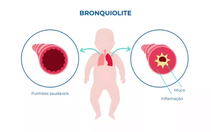 Seu filho está com tosse e falta de ar? Pode ser bronquiolite!