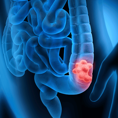 Câncer de intestino: o que é e por que devemos nos preocupar?