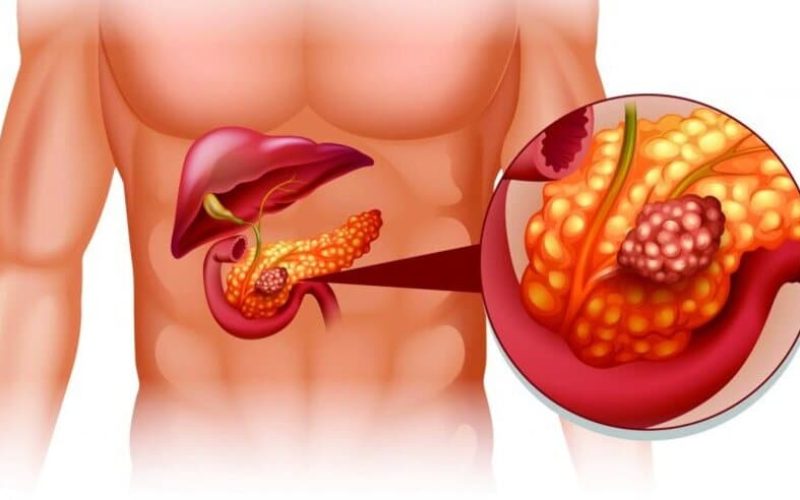 Câncer de Pâncreas: sintomas, diagnóstico e tratamento