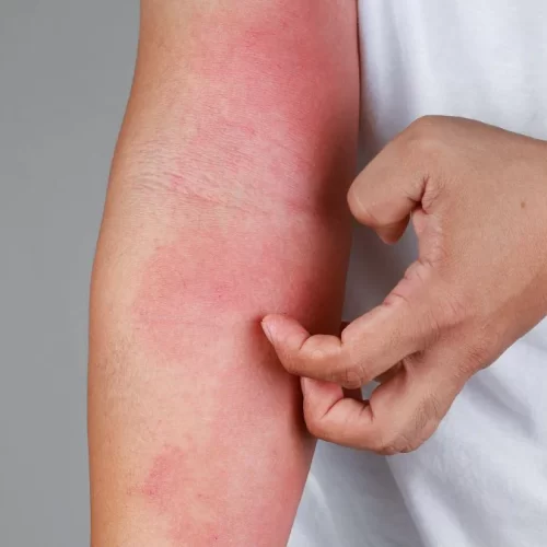 Diferença entre dermatite atópica e outras dermatites