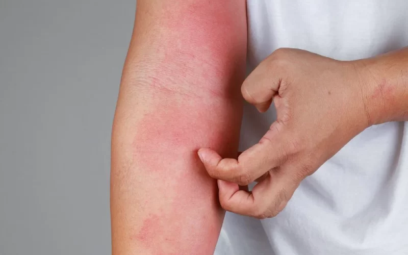 Diferença entre dermatite atópica e outras dermatites