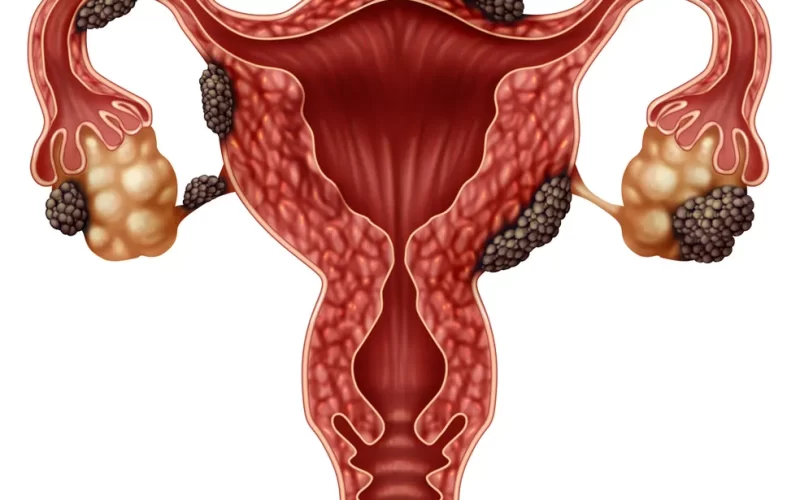 Guia de estudos: endometriose