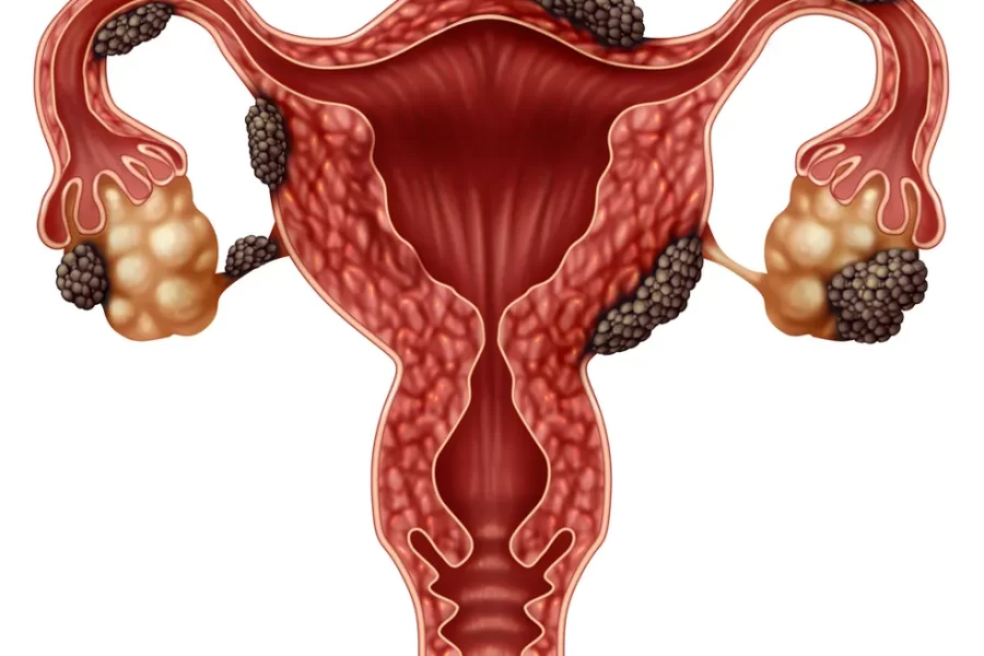 Guia de estudos: endometriose