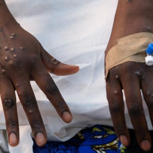 Cepa mais letal da MPox chega ao Brasil