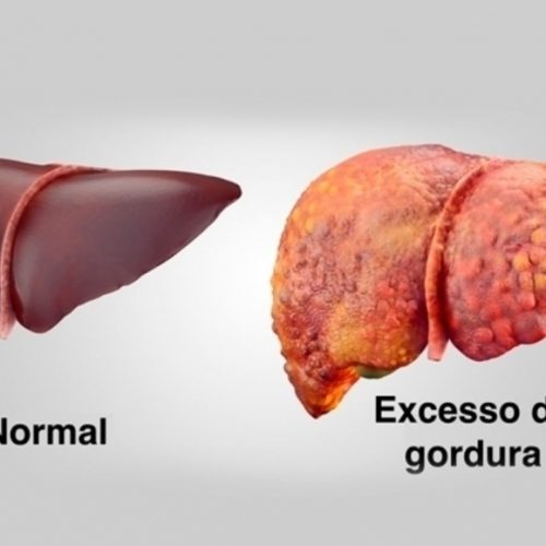 Esteatose Hepática: causas, sintomas e prevenção