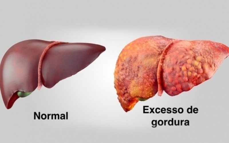 Esteatose Hepática: causas, sintomas e prevenção